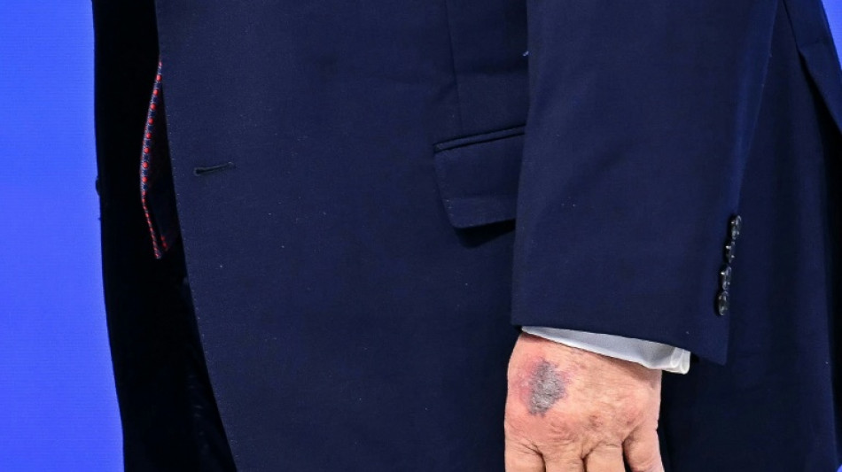 Trump atribuye moretones en su mano a golpe contra la mesa