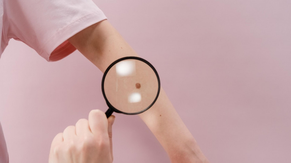 Istituita la giornata nazionale di prevenzione del melanoma